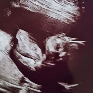 Ultraljud v13 och 20. 